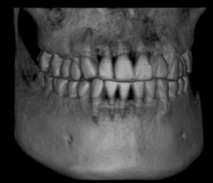Dental Implants Melbourne 3D xray