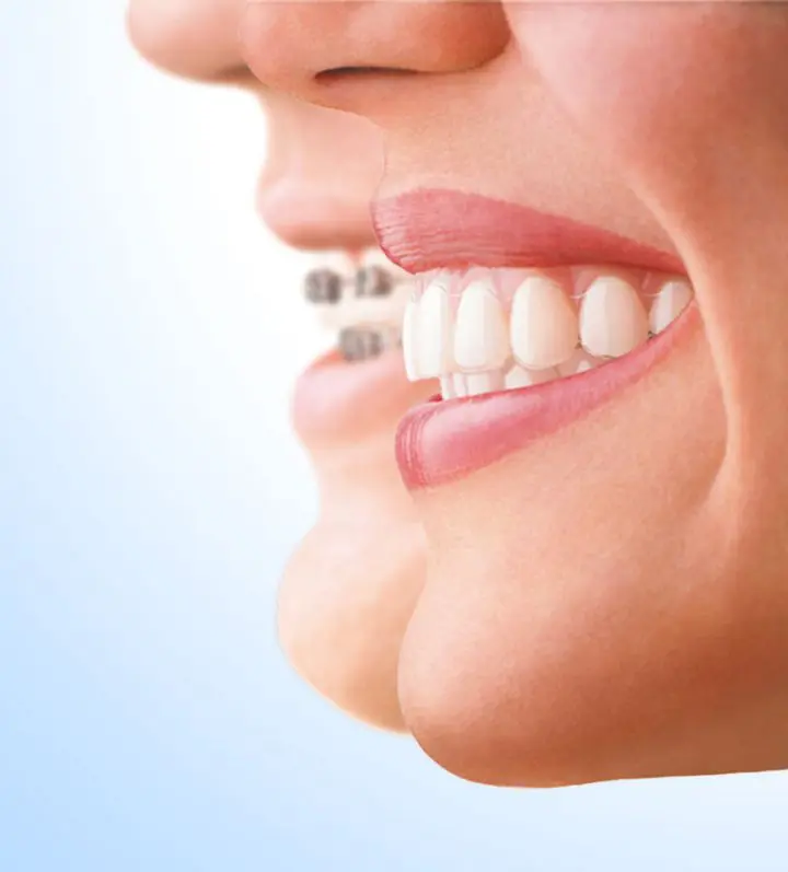Orthodontics Melbourne Traditional Metal Braces vs Invisalign Clear Aligners Essenden Braces Expert