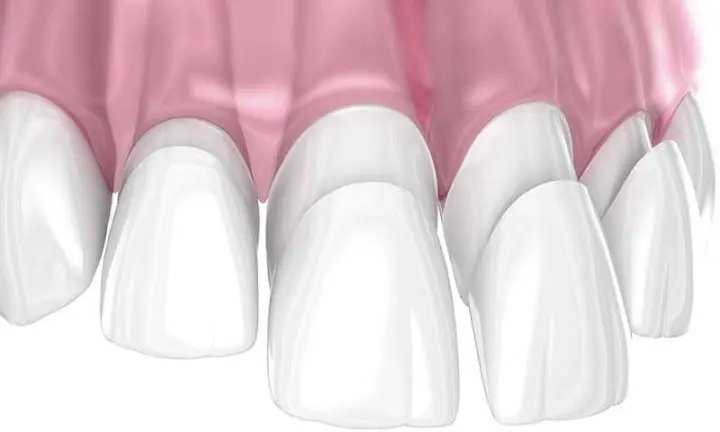 what-are-porcelain-veneers-3D-example-Essendon-dental-clinic-Melbourne what are porcelain veneers 3D example Essendon dental clinic Melbourne