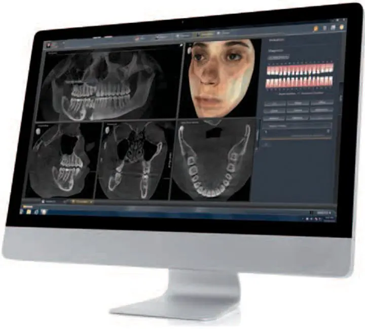 dental implants 3D xray imaging CBCT scanner Melbourne dental clinic Essendon