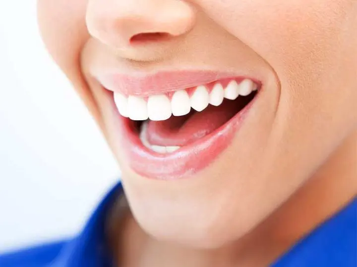 porcelain veneers Essendon dental clinic Melbourne perfect smile porcelain veneers Essendon dental clinic Melbourne perfect smile