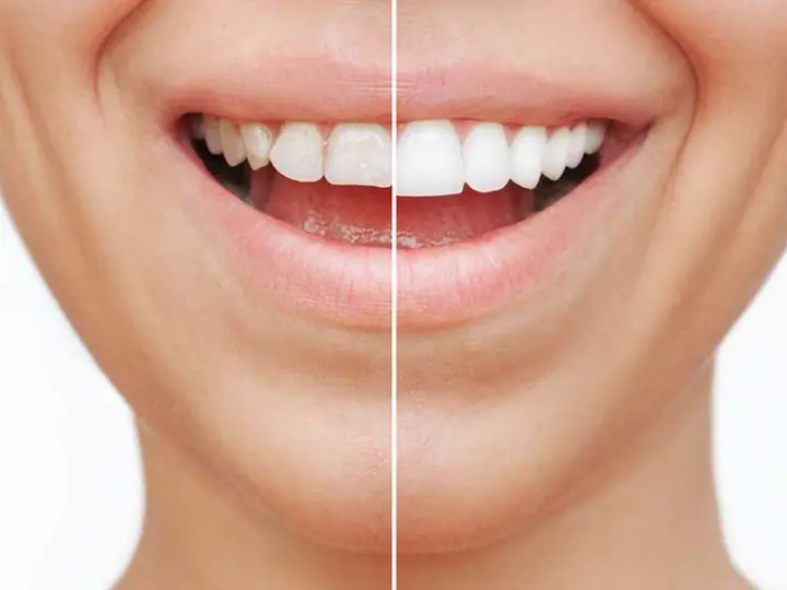 porcelain veneers benefits Essendon dental clinic Melbourne perfect smile before after example porcelain veneers benefits Essendon dental clinic Melbourne perfect smile before after example