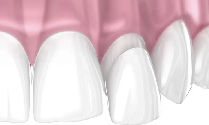 what are peg laterals 3D porcelain veneers covering incisors Essendon dental clinic Melbourne what are peg laterals 3D porcelain veneers covering incisors Essendon dental clinic Melbourne