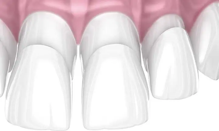 what are composite veneers resin dental bonding 3D example Melbourne dental clinic Essendon