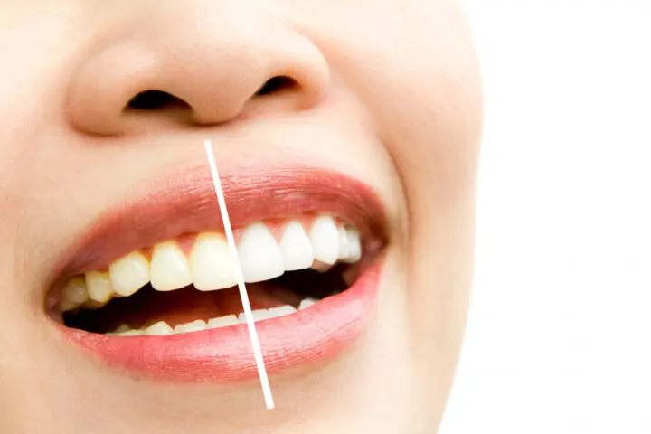 Teeth Whitening in Melbourne