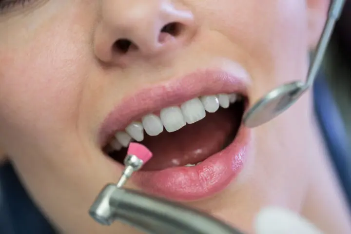 Teeth Cleaning in Melbourne