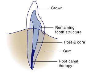 first bite dental cosmetic dentistry dental crowns dgrm-crown