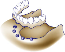 first bite dental cosmetic dentistry dentures diag-dentureimplant