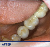 first bite dental cosmetic dentist smile-bridge-after