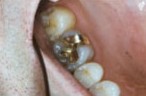 Gold fillings