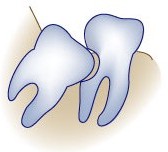 Damage to nearby molars by a wisdom tooth