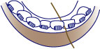 first bite dental orthodontics braces-flossing