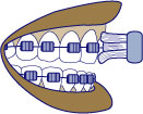 first bite dental orthodontics braces