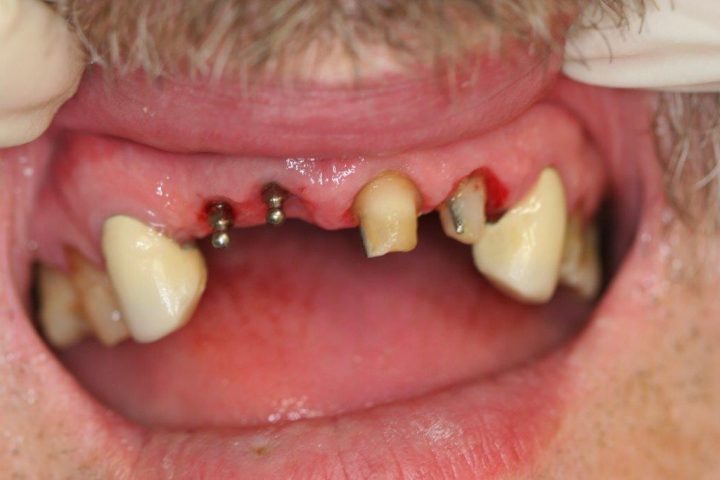 Image of patient's teeth prior to mini dental implants