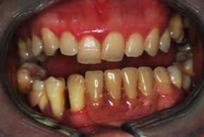Periodontics-essendon-after_03-LR