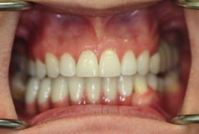 Periodontics-essendon-after_09-cropped
