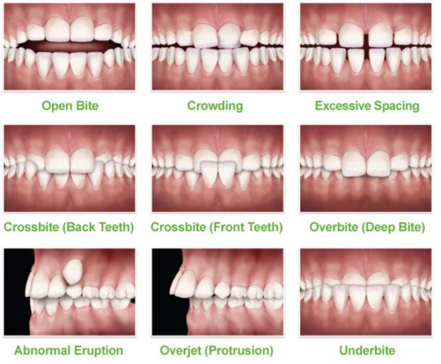 Kids Orthodontics Firstbite Dental Essendon Dentist