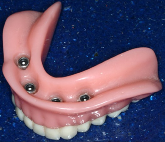 Rubber o rings hot sale for dental implants