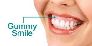gummy smile photo illustration