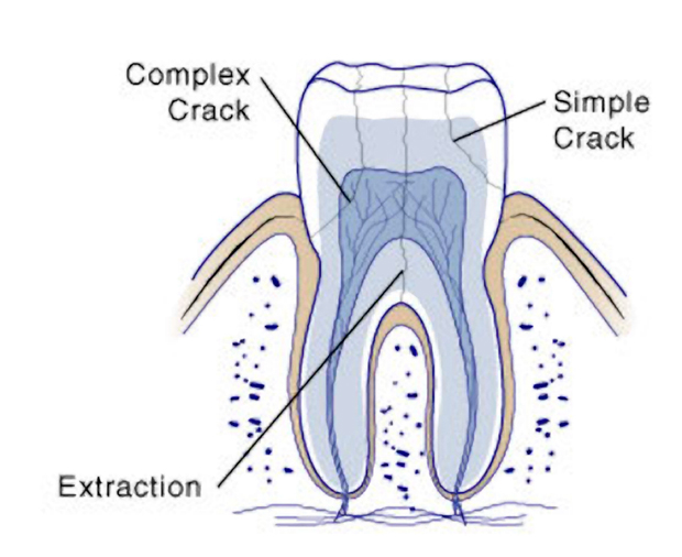 broken molar no pain