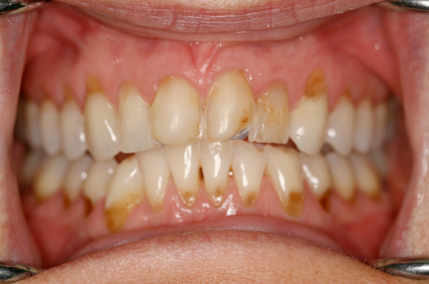 Erosion Teeth