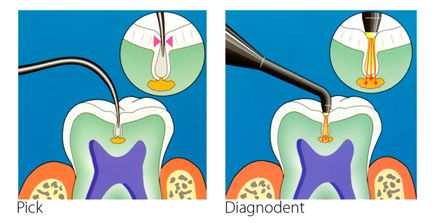 Diagnodent-laser-cavity-scanner