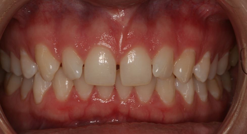 Before Peg Laterals treatment with Porcelain Veneers at Essendon dentist