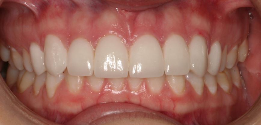 After Peg Laterals treatment with Porcelain Veneers at Essendon dentist