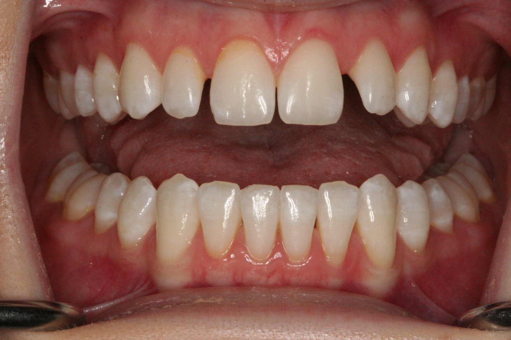 Peg Laterals before treatment with Composite Veneers at Melbourne dentist in Essendon