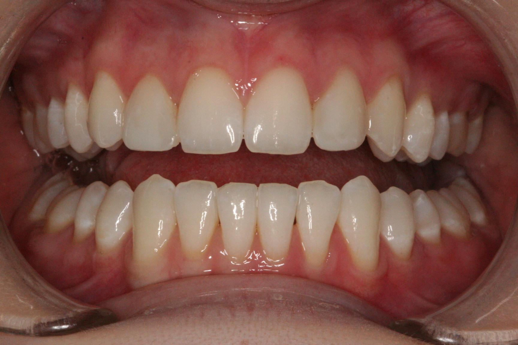 Peg Laterals after treatment with Composite Veneers at Melbourne dentist in Essendon