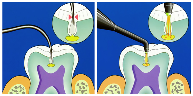 Detecting Hidden Cavities With A Laser Cavity Scanner Firstbite