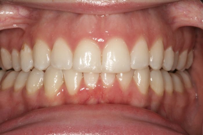 Invisalign Melbourne | Dentist Essendon | FirstBite Dental
