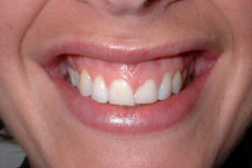 Gum Surgery Case 3a Hypermobility of upper lip Before