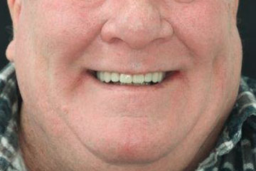 smile makeover options Melbourne dental implants implant-supported dentures after