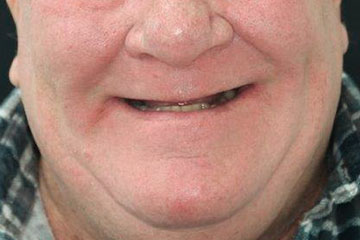 smile makeover options Melbourne dental implants implant-supported dentures before