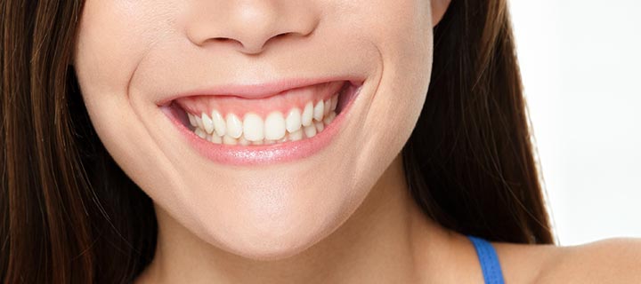 Gummy Smile Treatment Long Island - Esthetic Gum Contouring