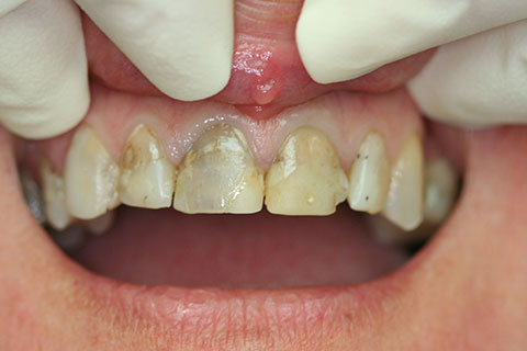 Dental Crowns Essendon Patient Melbourne Case Study-03-IMG_1657 1-Before