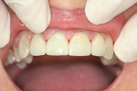 Dental Crowns Essendon Patient Melbourne Case Study-03-IMG_1771 2-After