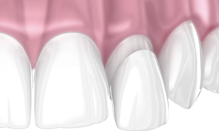 what are peg laterals 3D porcelain veneers covering incisors Essendon dental clinic Melbourne