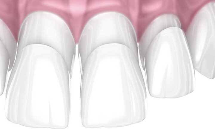 what are composite veneers resin dental bonding 3D example Melbourne dental clinic Essendon what are composite veneers resin dental bonding 3D example Melbourne dental clinic Essendon