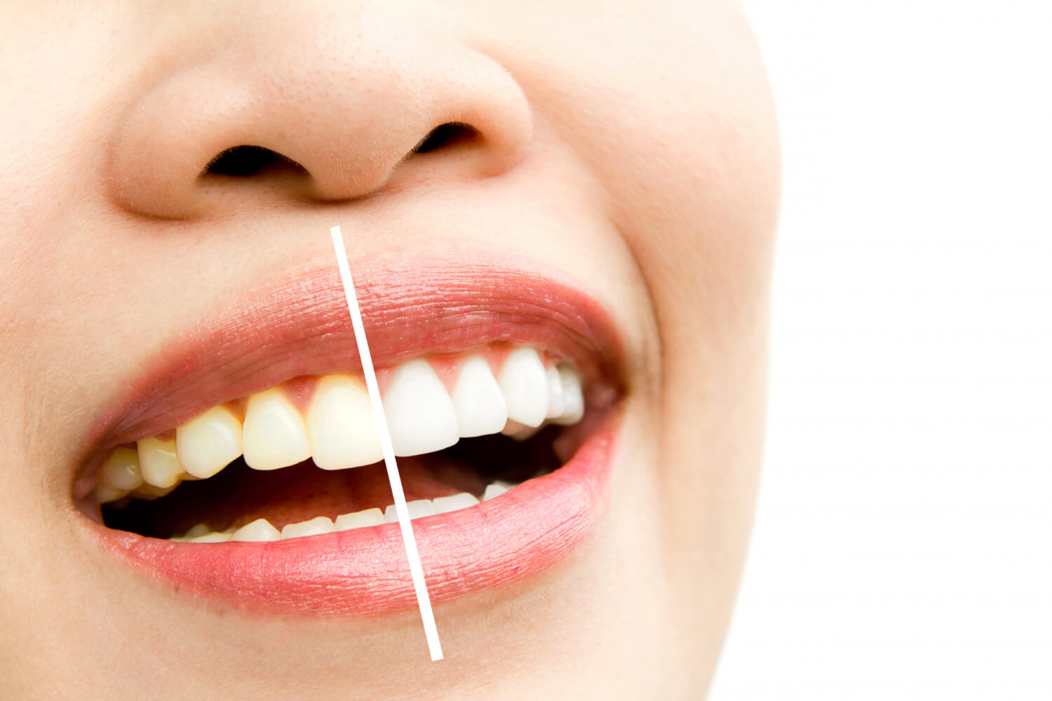 Teeth Whitening in Melbourne
