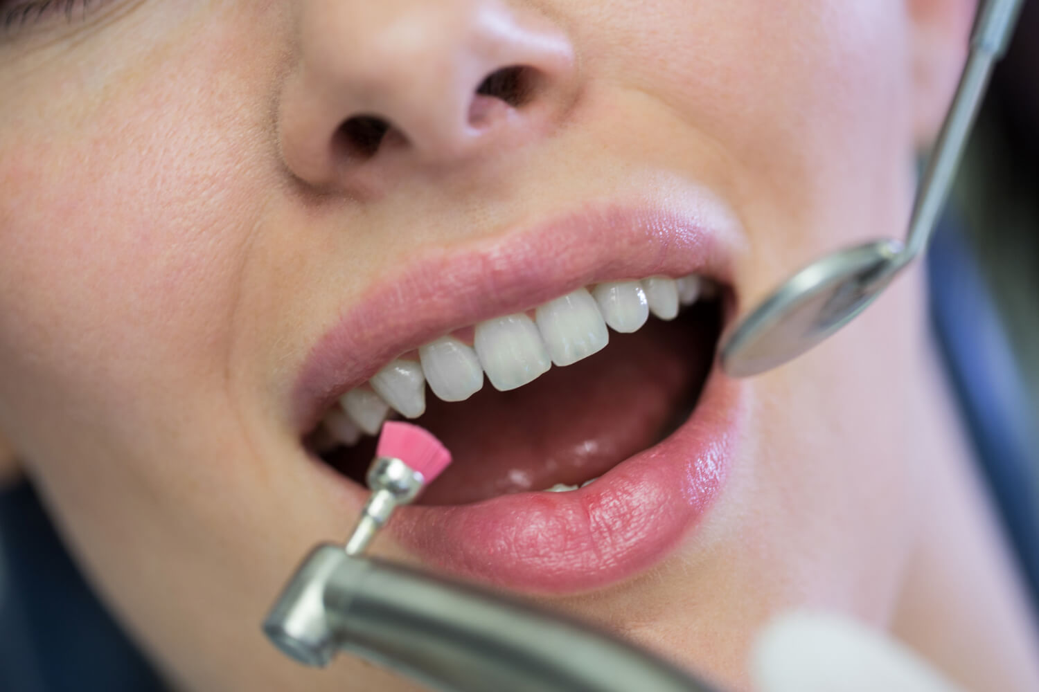 Teeth Cleaning in Melbourne